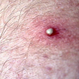acne pimple skin blemish