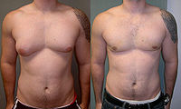 man-boobs-severe-asymmetric-gynecomastia 