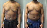 man-boobs-pseudogynecomastia