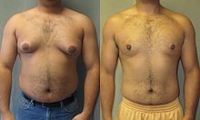 man-boobs-asymmetrical-gynecomastia .